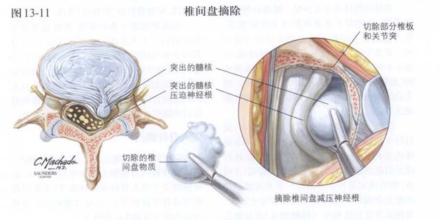 患上腰椎间盘突出，还能不能再骑自行车？专业人士为你解答！