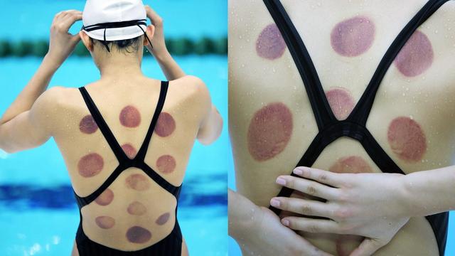 olympic_cupping.jpg